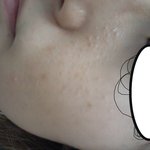 사진有有 피부 좀 봐주세요 ㅠㅠ 이거 <b>좁쌀</b>여드름 인가요??