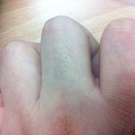 여자인데 손가락<털>이자랐어요ㅋㅋ(변화과정 사진 有)ㅋㅋㅋㅋㅋㅋㅋㅋㅋㅋㅋㅋㅋㅋ