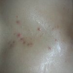 사진有)남잔데 가슴,턱피부 트러블 때문에 고민이에요 ㅜ