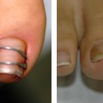 아직도 뽑거나 잘라요? -_-;; 발톱교정기 케이디(k-<b>d</b>) 치료