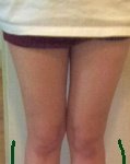 종아리 휜 다리 어떻게 하나요ㅠ