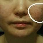 여드름흉터<b>피부</b> 남친한테 차이고 <b>변신</b>했어요