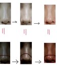필러 잘 아시는분 있나요. 필러 부작용인거 같은데 해결 할 곳이...