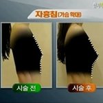 자흉침플러스2 맞으려고요..