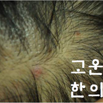 지루성두피염이란?