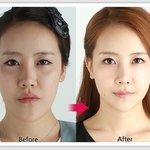 페이스라인 <b>전후</b>사진