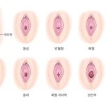여자의 처녀막에 대해 알아보장