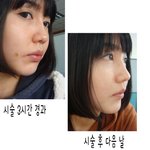 [삼성동피부과/에스피부과] 팔자<b>주름</b>+콧대필러+턱보톡스 어때요?