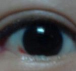 눈<b>뒤트임</b> 부작용이에요... 제발 도와주세요