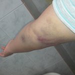 응급실에서 링거맞고 <b>채혈</b>했는데 팔이 징그럽게 되었어요 ㅠㅠ