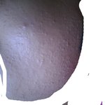 여드름치료를 2달 넘게했는데 망쳤는데 환불<b>요청</b> 가능하나요?(약혐오주의)