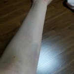 <b>헌혈</b>후 나의 팔뚝은 불쌍했다....(사진 있음)