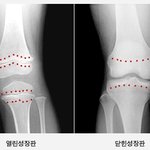 <b>성장판</b> 열려있으면