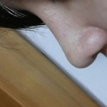 코수술했는데 티나나요?