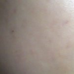 {666 개인적으로 성인여드름 총정리편 666}