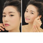 이런 <b>눈</b>은 어떻게 <b>수술</b> 해여????????/
