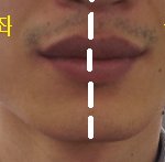 제 <b>비대칭</b> 턱 좀 봐주세요.