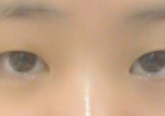 쌍수할까요 ..?(사진 有)