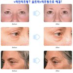 v라인리프팅, 울트라v리프팅으로 받자!