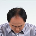 <b>안면</b>지루성피부염과 탈모의 상관관계
