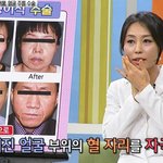 여유만만에 소개된 <b>중년</b>성형~ 한방침으로 주름을 없앤다고 하네요~