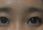 쌍수했는데 좀 봐주세요~