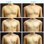 요즘은 어좁성형도 있나보네