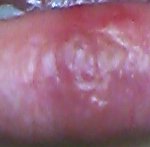 입술<b>물집</b> 별로안혐오..헤르페스바이러스