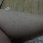 팔다리에상처때문에 ㅠㅠ..어떡하죠