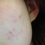 파란만장한! 여드름피부 극복 사연