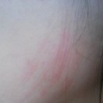 [사진]피부관리(mts)받다가 얼굴에 <b>상처</b> 났어요