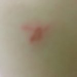 <b>흉터</b> 메롱같이 생겼다