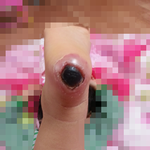 아기발이 깁스풀고 이렇게됐는데..