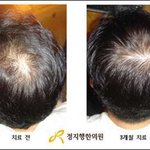 머리카락이 이렇게 중요했군요.. 탈모로 엄청 고생했슴당~