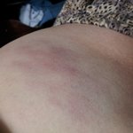 훌라후프로 <b>뱃살</b>빼기 멍든사진혐오주의