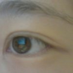 <b>쌍커플</b> 앞트임 자국이 남았어요ㅠㅠ (사진있어요)