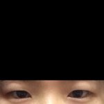 <b>쌍수</b> 앞트임 후기