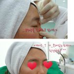 코필러 한달 후, 셀카찍기가 새로운 취미~ㅋㅋㅋ