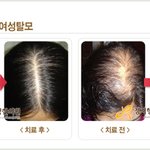 다이어트 잘못해서 머리카락만 빠졌어요~~~~