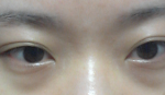 다크<b>서클</b>이너무심해요