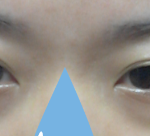 다크<b>서클</b>이너무심해요