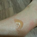 화상입은환자 <b>진료</b> 거부하는 못된 피부과를 고발합니다