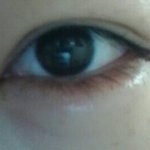 도와주세요ㅜㅜ필러부작용