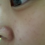 톡커님들제피부좀요ㅠㅜ