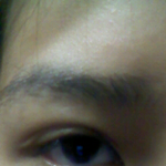 쌍수했는데 <b>그위</b>에 또생겼어요