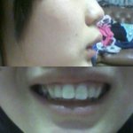 <b>치아</b>교정해야할까요?