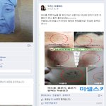 여드름 없애는 방법중에 여드름 짜고나서 자국안생기게 하는 재생연고가...