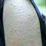 팔에 <b>닭살</b>이 너무 심해요 혐오주의 ㅠㅠ