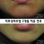 지루성<b>피부염</b>이란?