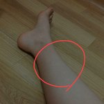 다리에 하얀<b>점들</b>이 생겼어요ㅠㅠ